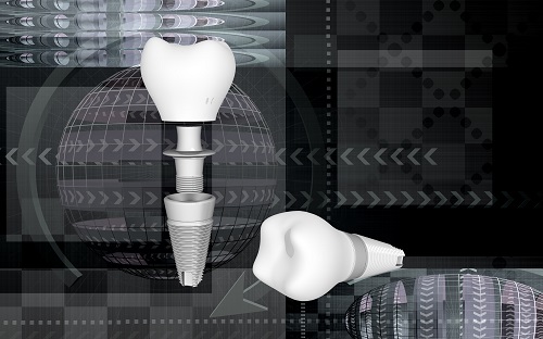 Future of Dental Implants